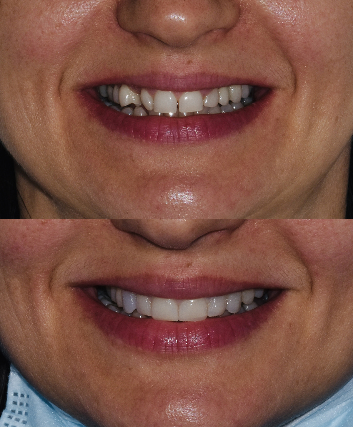 Faccette Dentali - Studio Dentistico 2M